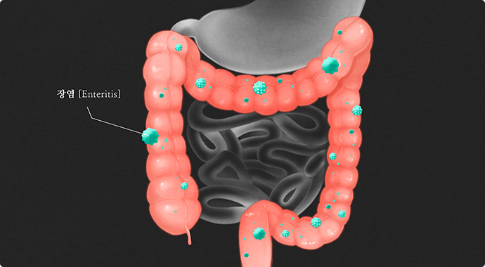 우리 몸의 장에 염증이 생긴 것을 표현한 일러스트