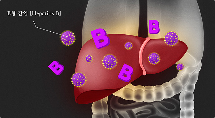 우리 몸의 간에 b형 간염바이러스를 표현한 일러스트
