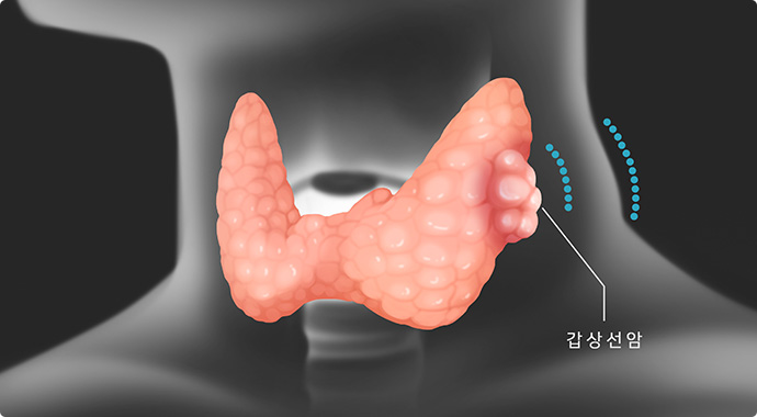 우리 몸에 갑상선위에 갑상선 암이 생긴것을 표현한 일러스트